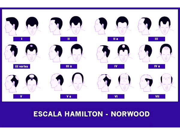 escala hamilton alopecia