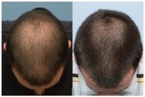 disimular-calvicie-ante-despues-finasteride