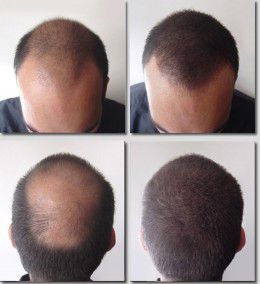 disimular-calvicie-ante-despues-maquillaje-capilar