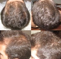 disimular-calvicie-ante-despues-minoxidil