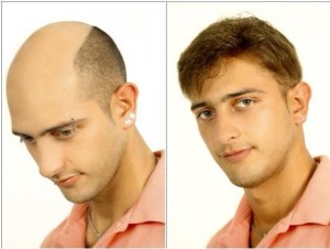 disimular-calvicie-ante-despues-protesis-capilar