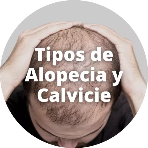 Tipos de Alopecia