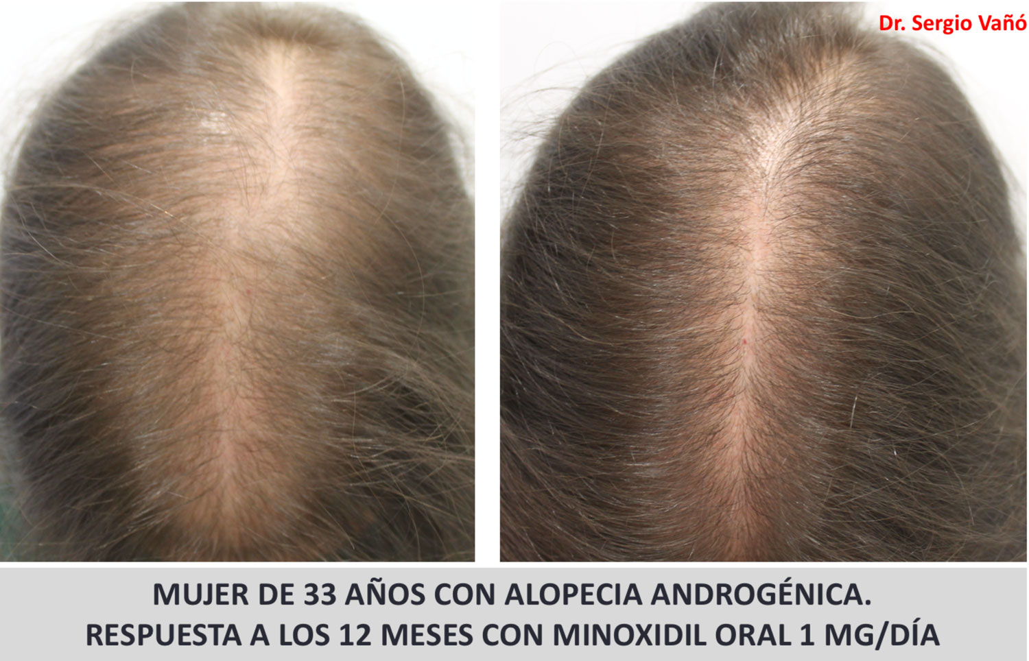 minoxidil antes y despues mujeres