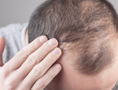 Alopecia Androgénica: Causas y soluciones