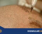 microinfusión de medicamentos contra la calvicie