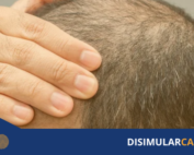 exosomas para la calvicie