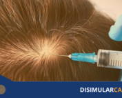 alopecia androgenética