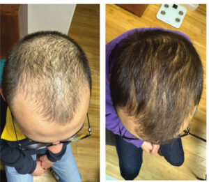 suplementos para la alopecia androgenética