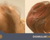 prótesis capilar 5ta dimensión