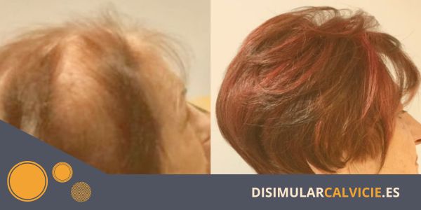 prótesis capilar 5ta dimensión