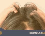 minoxidil y triamcinolona calvicie femenina